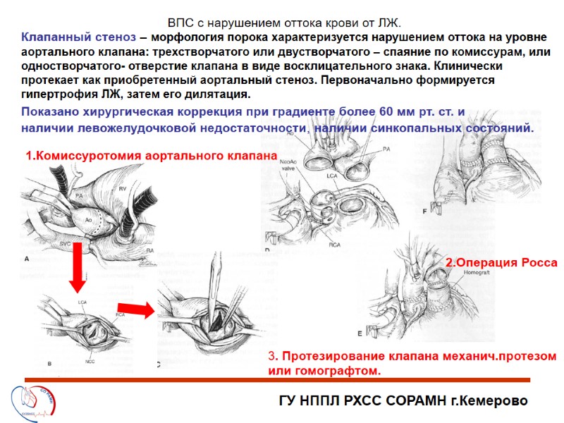 ГУ НППЛ РХСС СОРАМН г.Кемерово ВПС с нарушением оттока крови от ЛЖ. Клапанный стеноз